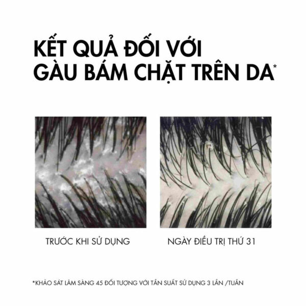 Dầu gội trị gàu Vichy Dercos Anti Dandruff xanh 200ml sạch gàu, giảm ngứa, làm dịu da dầu | eustore.com.vn
