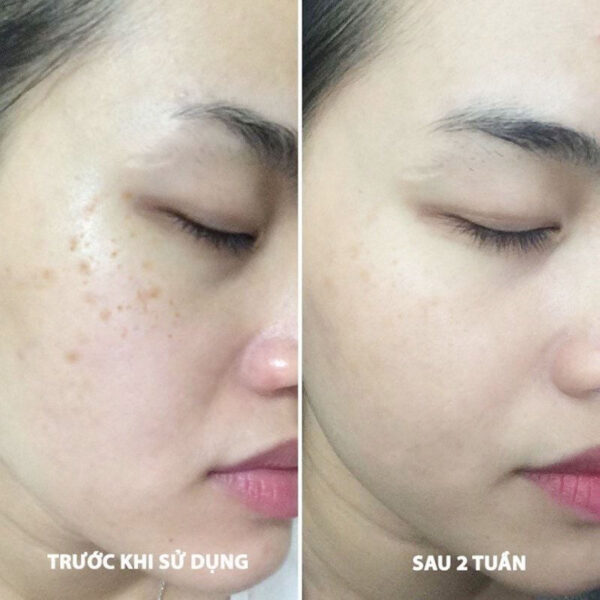 Bút chấm trị nám, tàn nhang Eucerin Spotless Brightening Spot Corrector 5ml có tốt không? | eustore.com.vn