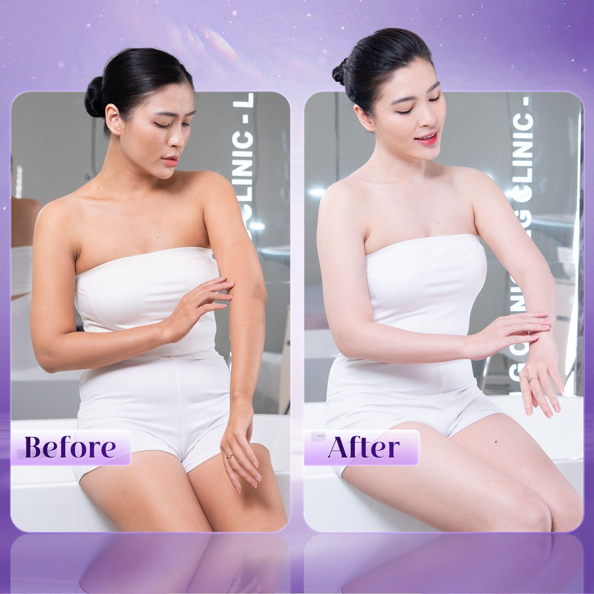 Kết quả tắm trắng bằng công nghệ Smart Light 6D tại LG Clinic